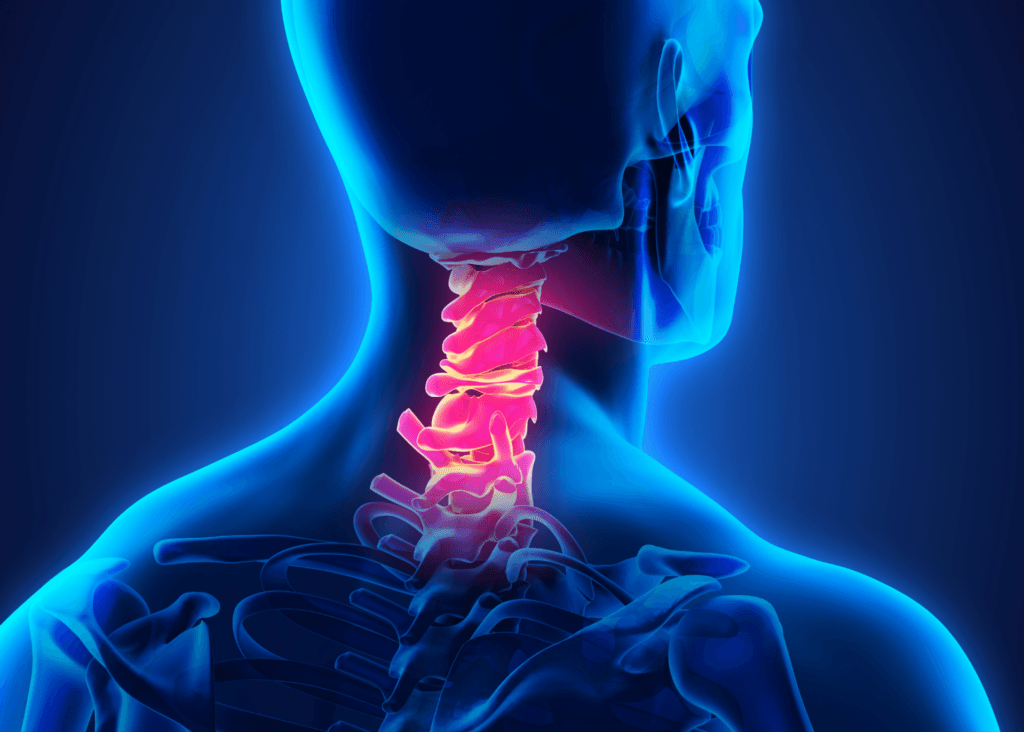 Cervical Spondylosis (Neck Arthritis)