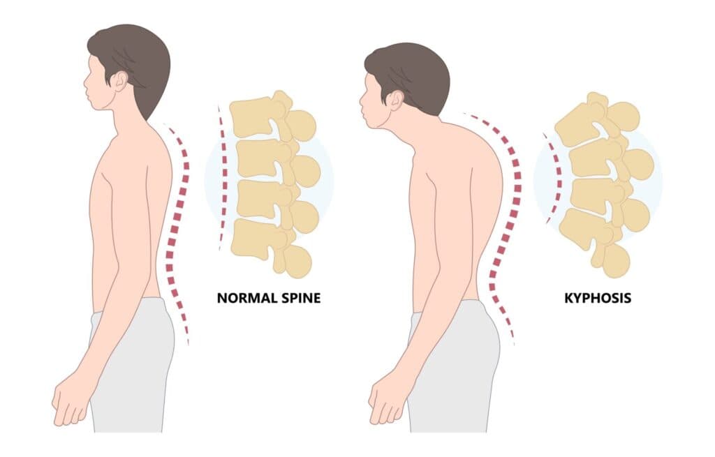 Kyphosis (Hunchback Spine)