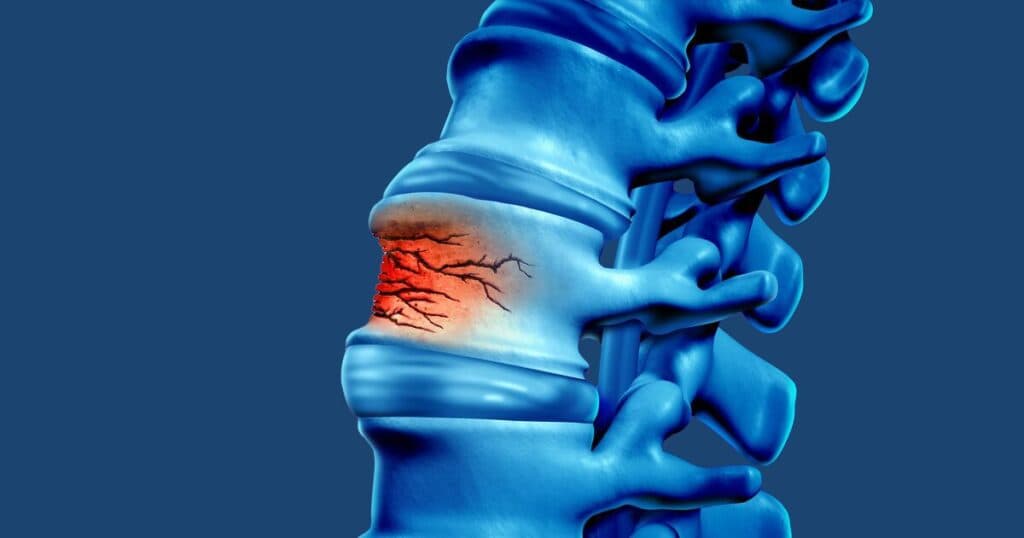 Osteoporotic Vertebral Compression Fractures
