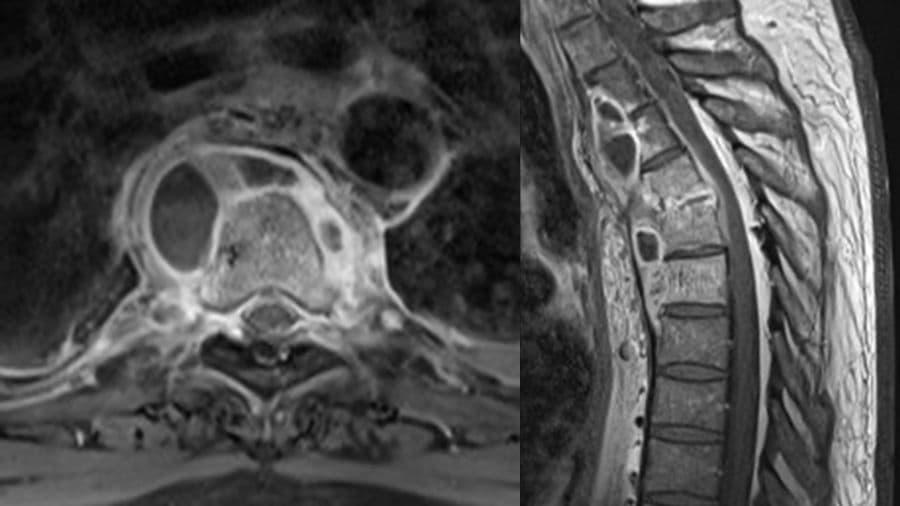 Pott’s Spine