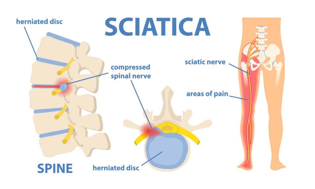 Sciatica (Leg Pain from Nerve Compression)